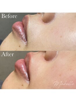 マベル シュガーリング(Mabelle)/お顔脱毛