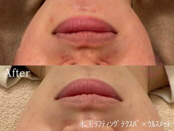 サロンヴェアリー 広尾(salon vary)/ニキビの赤みに！#lbm