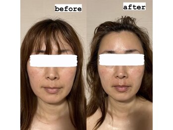 エクレクティック(ECLECTIC)/小顔/宇都宮エステ