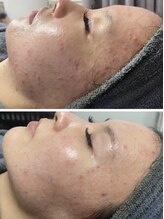 ココ 千里丘(Cocoh)/《全顔》ハーブピーリング