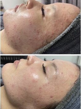 ココ 千里丘(Cocoh)/《全顔》ハーブピーリング