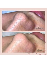 ジプソフィラフィフティドット(gypsophira15.)/施術