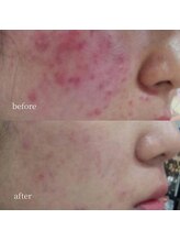 アーネスト 大阪心斎橋店(EARNEST)/韓国式光美容【 生理前ニキビ 】