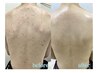 【背中全体】繰り返す背中ニキビ改善ケア