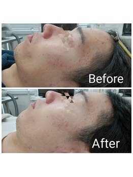 レン(Ren)/ラテスパ<美白/毛穴/くすみ>