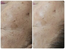 リセラージュ(Recellage)/陶肌トリートメント×グロッティ