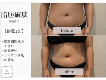サロン ド パーフェクション(Salon de Perfection)/脂肪冷却