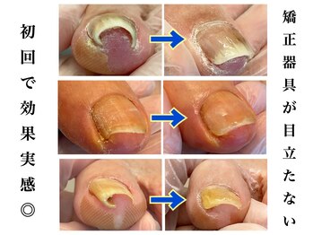 巻き爪専門院002 二俣川の写真/【知識豊富な高技術スタッフのマンツーマン施術】辛い足の悩みに寄り添い、根元から矯正し再発を防ぐ★