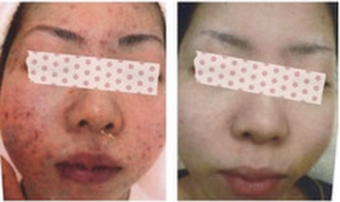 【毛穴.ニキビケア】最強9STEP(毛穴洗浄+生コラ+MC2X・銅ペプチド)120分\5500