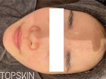 トップスキン 栄(TOPSKIN)/肌質改善プログラムTCLINE/REVI