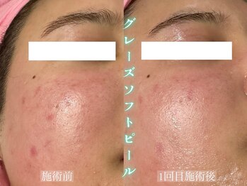 スイッチプラス(switch+)/ダウンタイムなしの肌改善