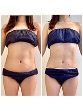 ゼロ シロカネ(ZERO SHIROKANE) 脂肪分解剤 集中ケア