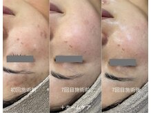 ヒュウ(hue.)/韓国発最新肌管理[セルマン]