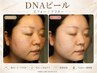 【肌質改善◎】剥離無DNAピーリング!憧れの水光ツヤ肌へ◆60分¥25000→¥19800