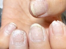 サロン ド ワカ(Salon de WAKA)/お爪の育成　ケア前