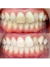 ラヴィス(RAVIS)/セルフホワイトニング