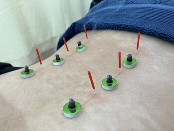 べっぷ餅ヶ浜鍼灸院/疲労回復