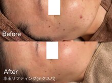 サロンヴェアリー 広尾(salon vary)/トラブル肌の改善に#ldm