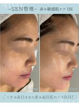 スキンラボアメリ(skin lab. ameri)/お悩み…敏感肌赤みくすみ