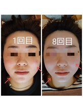 美藤鍼灸院/美容鍼のBefore After