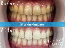 ホワイトニングカフェ 市川店(Whitening Cafe)
