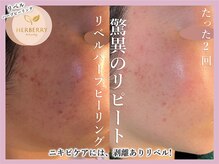 ハーバリー ハーブピーリング 大阪梅田店(HERBERRYハーブピーリング)/梅田ハーブピーリングHERBERRY