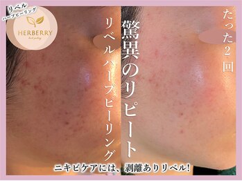 ハーバリー ハーブピーリング 大阪梅田店(HERBERRYハーブピーリング)/梅田ハーブピーリングHERBERRY