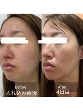 マリー(Mary.)/ハーブリプロ★ハーブピーリング