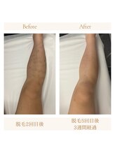 アルテ(ARTE)/脚脱毛ビフォーアフター