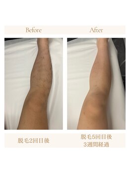 アルテ(ARTE)/脚脱毛ビフォーアフター