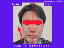フェレザ 新潟(Felleza)/サーマルフラクショナル