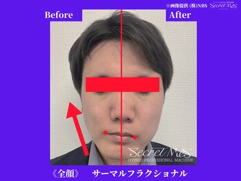フェレザ 新潟(Felleza)/サーマルフラクショナル