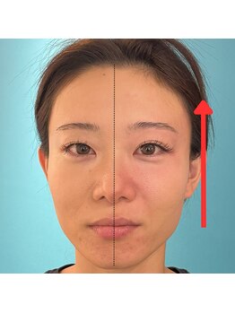 ネクスフィット(Nexfit)/小顔矯正フェイスリフトの効果