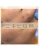 シーベル 新宿/ハーブピーリング/ニキビケア