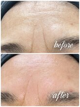 ミアローザ(Mia Rosa)/光フェイシャル☆シワケア