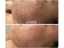 ラニィエンボーテ(La Nhien Beaute)/最先端微細針美容～