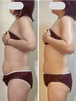 ブルームオーラ 月(BLOOM AURA)/1回で激変!ぽっこりお腹解消!