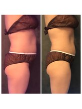 サニー(SUNNIE)/脂肪冷却痩身8カップ［6回］