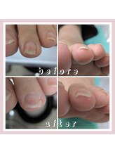 巻き爪補正店 大阪なんば店/小さいお爪の巻き爪