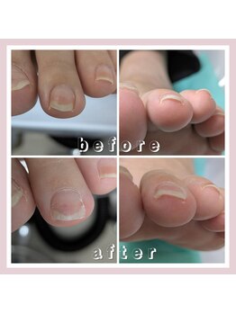 巻き爪補正店 大阪なんば店/小さいお爪の巻き爪