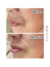 サロンゼロ 池上店(Salon ZERO)/IPL光フェイシャルでシワ改善