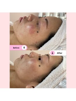 アネラ(ANELA)/赤み　痒み