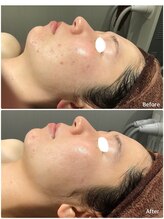 レヴィア 高岡店(REVIA)/フェイシャル★Before/After