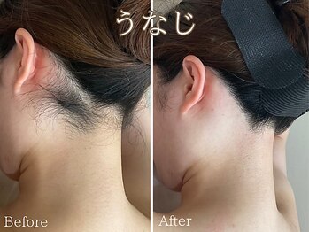 シエナ(ciena)/うなじシュガーリング脱毛
