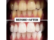 ホワイトニングサロン 宝塚/Before&After美白ホワイトニング
