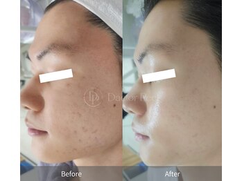 ミベル(MeBell)/ダクトピール】毛穴/ニキビケア