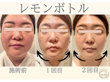 エトワール(etoile)/レモンボトル/