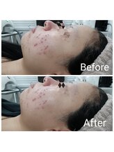 レン(Ren)/光フェイシャル<小顔/毛穴/シミ>