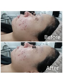 レン(Ren)/光フェイシャル<小顔/毛穴/シミ>