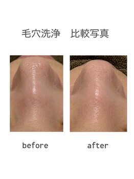エステサロンひかりの写真/毛穴洗浄×美容液導入で透明感ある素肌へ。毛穴・くすみ・ハリ不足にアプローチする本格フェイシャルサロン